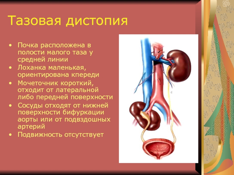 Аномалии мочеточников презентация