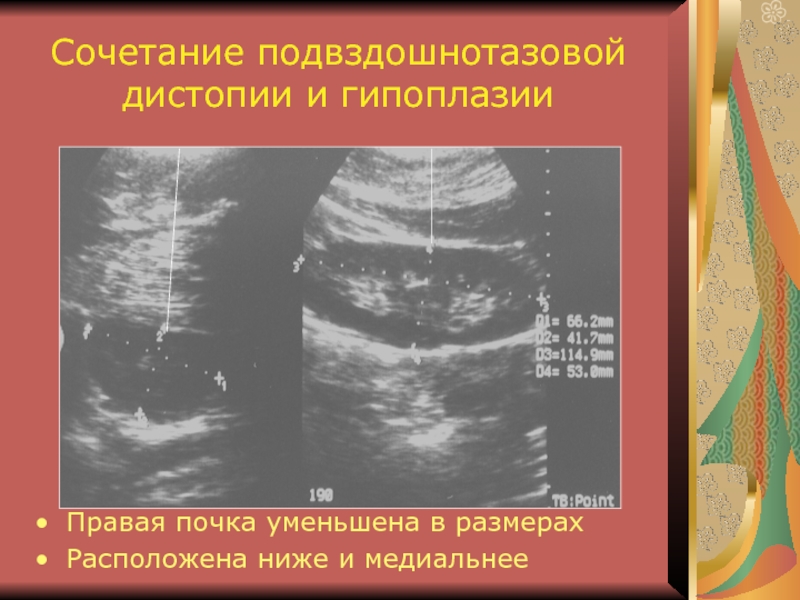 Аномалия развития почек презентация