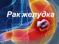 Рак желудка