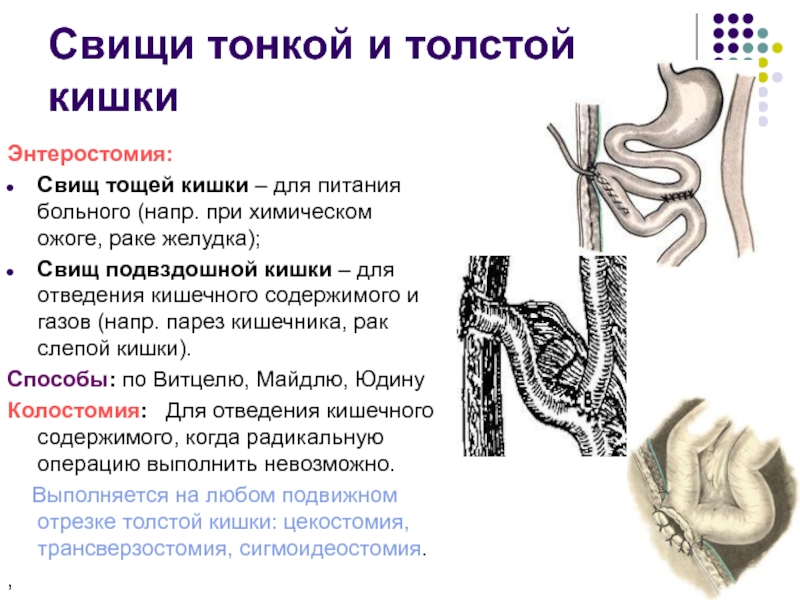 Лекция № 6 Свищи тонкой и толстой кишкиЭнтеростомия:Свищ тощей кишки – для питания больного Свищи тонкой и толстой кишкиЭнтеростомия:Свищ тощей кишки – для питания больного (напр. при химическом ожоге, раке желудка);Свищ