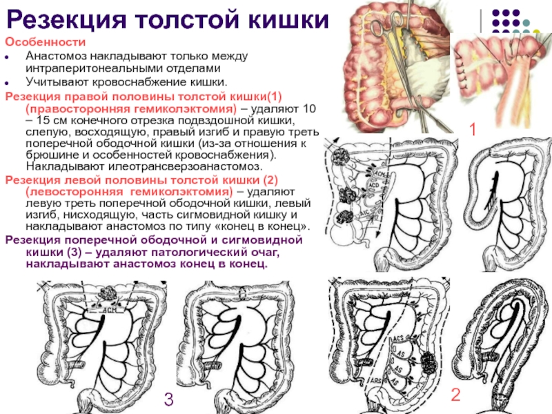 Лекция № 6 Резекция толстой кишкиОсобенностиАнастомоз накладывают только между интраперитонеальными отделамиУчитывают кровоснабжение кишки.Резекция правой Резекция толстой кишкиОсобенностиАнастомоз накладывают только между интраперитонеальными отделамиУчитывают кровоснабжение кишки.Резекция правой половины толстой кишки(1) (правосторонняя гемиколэктомия) –