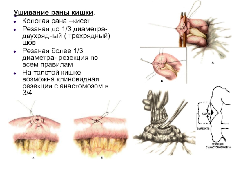 Лекция № 6 . Ушивание раны кишки.Колотая рана –кисетРезаная до 1/3 диаметра- двухрядный ( . Ушивание раны кишки.Колотая рана –кисетРезаная до 1/3 диаметра- двухрядный ( трехрядный) шов Резаная более 1/3 диаметра-