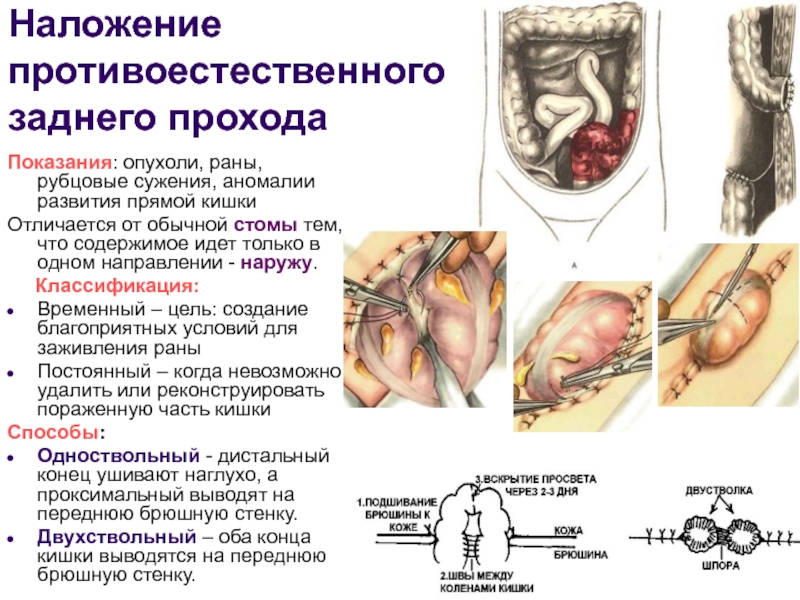 Лекция № 6 Наложение противоестественного заднего проходаПоказания: опухоли, раны, рубцовые сужения, аномалии развития прямой Наложение противоестественного заднего проходаПоказания: опухоли, раны, рубцовые сужения, аномалии развития прямой кишкиОтличается от обычной стомы тем, что