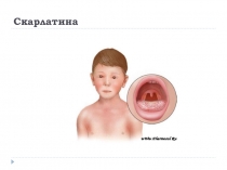 Скарлатина