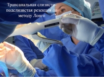 Трансанальная слизисто -подслизистая резекция по методу Лонго