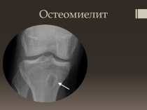 Остеомиелит
