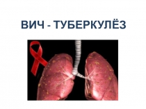 ВИЧ - ТУБЕРКУЛЁЗ