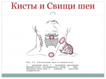 Кисты и Свищи шеи