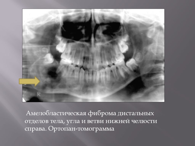 Амелобластическая фиброма дистальных отделов тела, угла и ветви нижней челюсти справа. Ортопан-томограмма