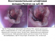 Восстановительная штифтовая вкладка Pentron на зуб 48