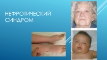 Нефротический синдром