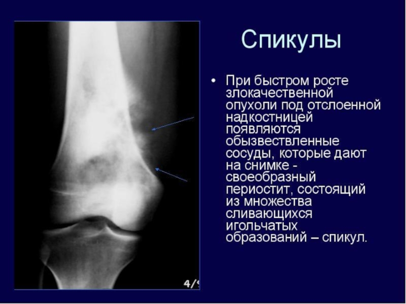 Злокачественные опухоли костей презентация