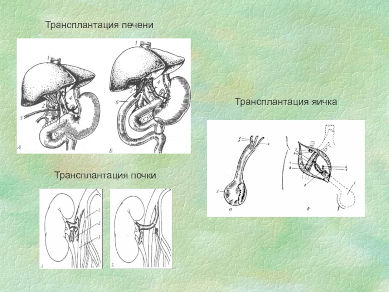 Трансплантация почки схема