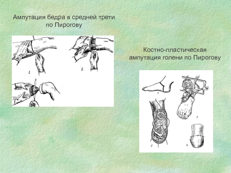 Пирогов костно пластическая ампутация голени