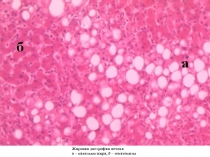 Жировая дистрофия печени
а – капельки жира, б – гепатоциты