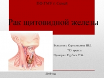 Рак щитовидной железы