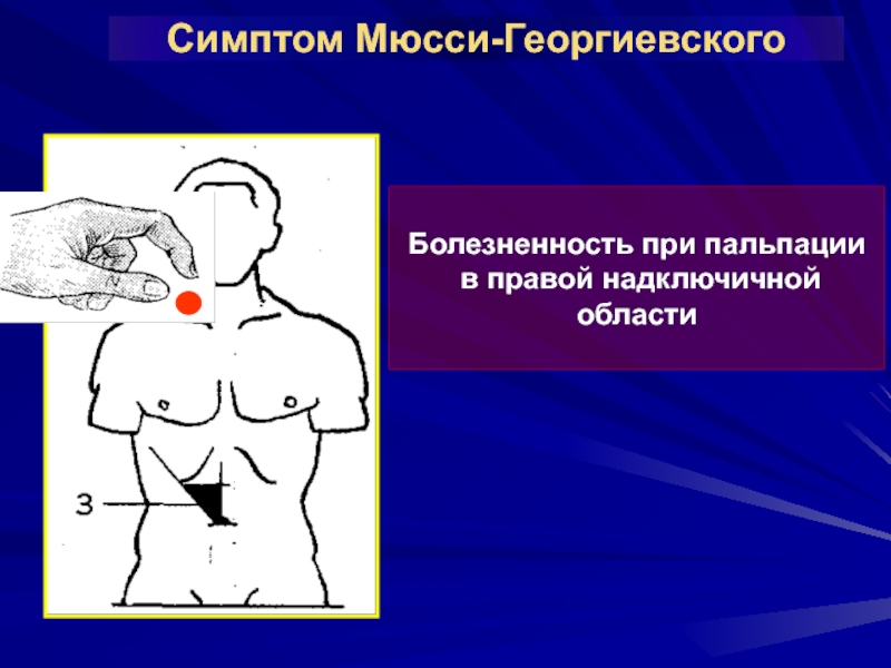 Болезненность при пальпации. Мюсси Георгиевского при. Синдром Мюсси Георгиевского. Симптом Гено де Мюсси-Георгиевского. Симптом Мюсси (френикус-симптом).