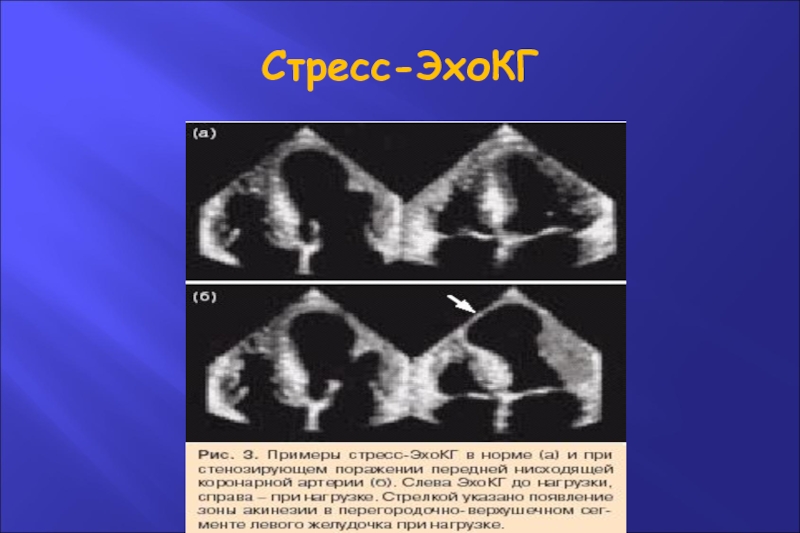 Стресс эхокг презентация