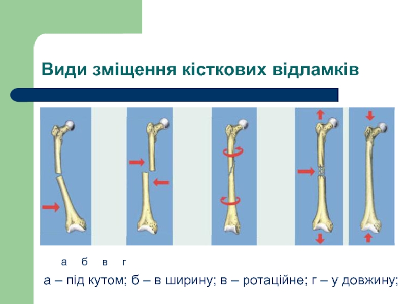 Ширина кости. Виды смещения костных отломков при переломе. Типы смещения отломков при переломах. Краниальное смещение отломков. Виды смещения костных отломков в двух проекциях.