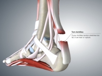 Хирургия сухожилий + ахила