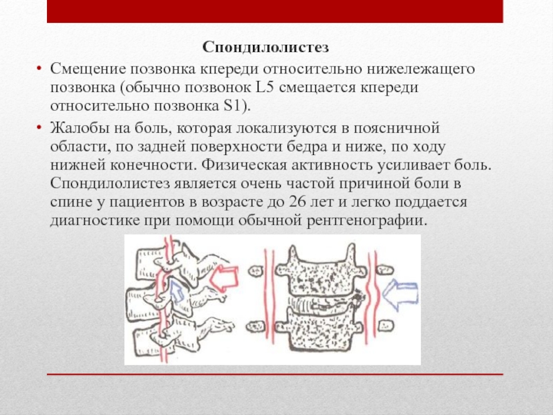 Как лечить смещение позвонков. Смещение позвонка l5 кпереди. Спондилолистез позвоночника l5. Спондилолизный спондилолистез l4 l5 позвонка. Смещение тела l5 позвонка кпереди до 3 мм.