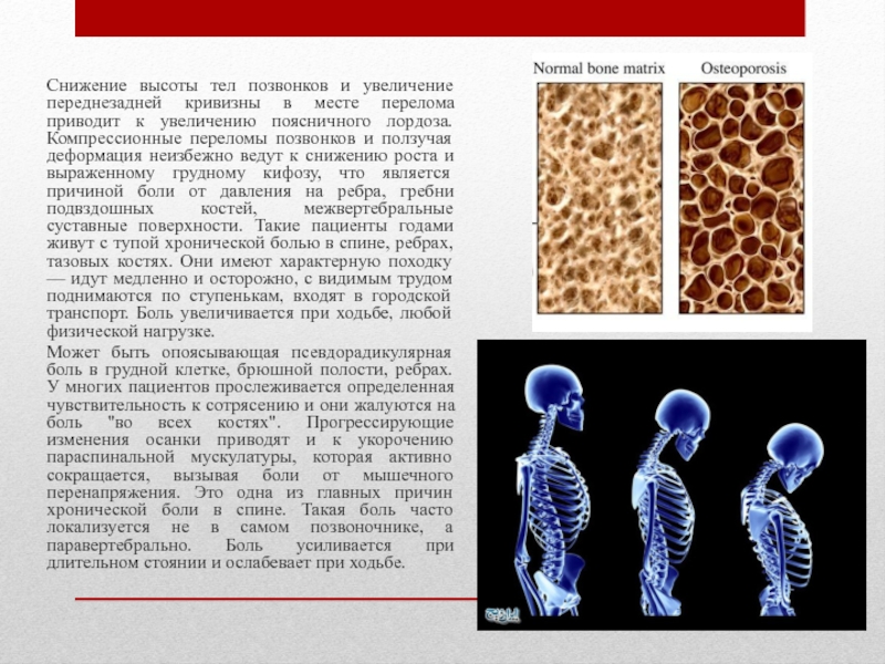 Организм сокращение. Снижена высота тела позвонка. Снижение тел позвонков. Снижение высоты тела позвонка рентген. Снижение высоты тела позвонка причины.