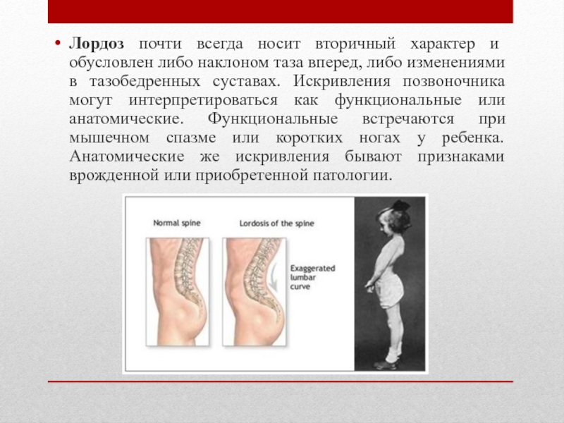 Лордоз это. Патологический лордоз. Лордоз таза. Признаки лордоза. Поясничный лордоз норма.