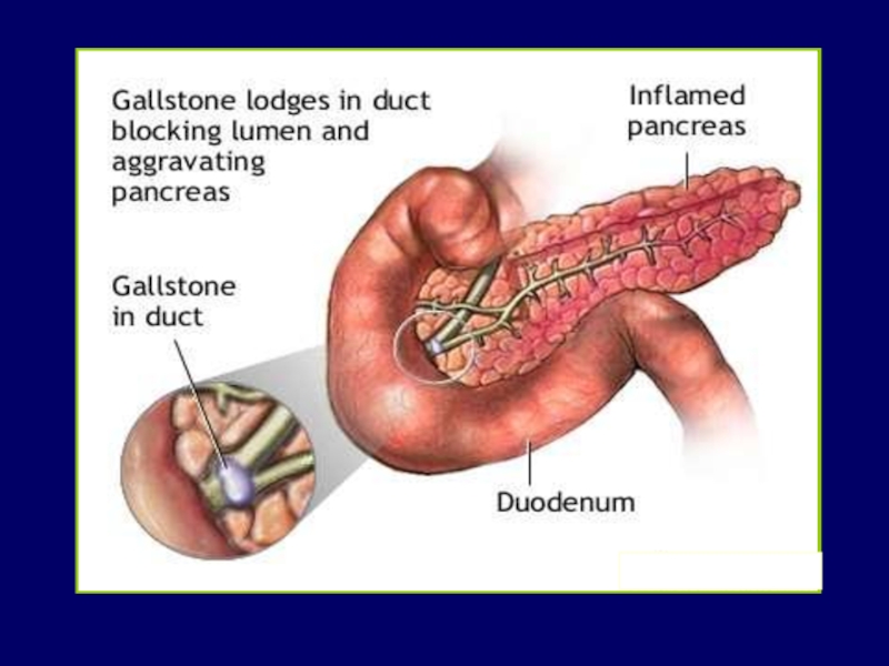 В поджелудочной бывают камни. Камни в поджелудочной железе. Паразиты в поджелудочной железе. Differential diagnosis of distructive pancreatitis and abortive PANCREATIRIS.