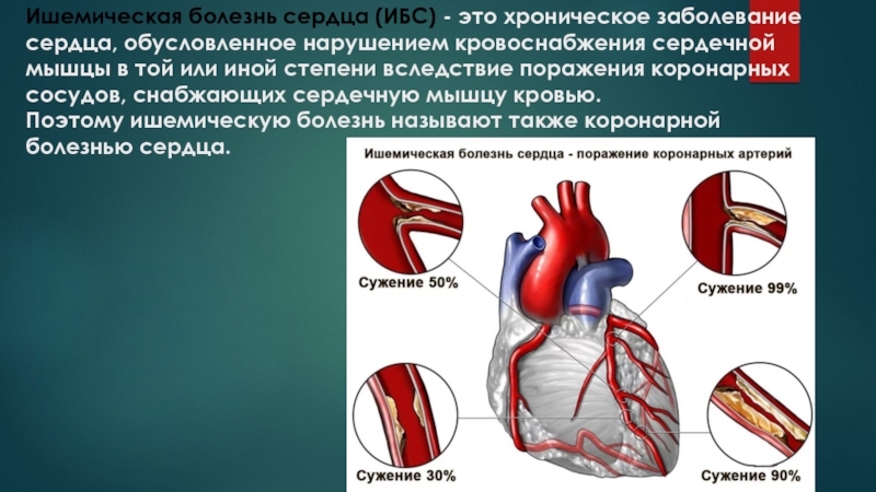 Ишемия мышц. Ишемическая болезнь сердца (ИБС). Ишемия коронарных сосудов.