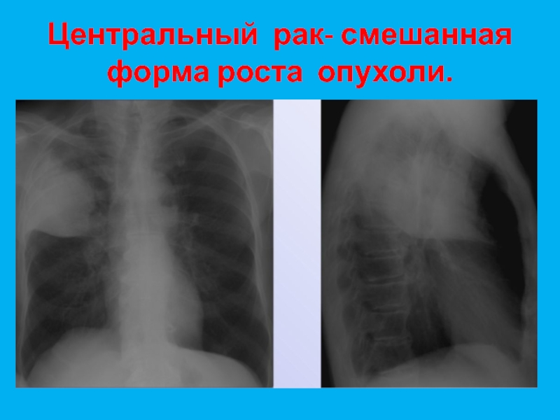 Центральный рак. Центральная опухоль легкого. Центральный tumor правого легкого. Центральная опухоль правого легкого. Смешанная форма роста опухоли.