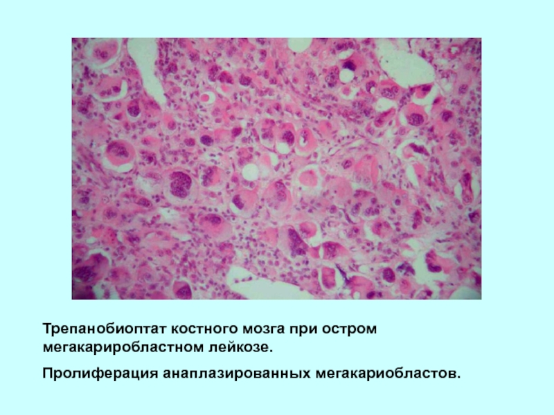 Пересадка костного мозга при лейкозе. Трепанобиоптат костного мозга. Трепанобиопсия при остром лейкозе. Острый лейкоз костный мозг. Костный мозг при лейкозе.