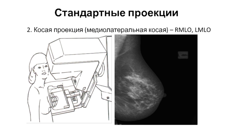 Проекции в маммографии