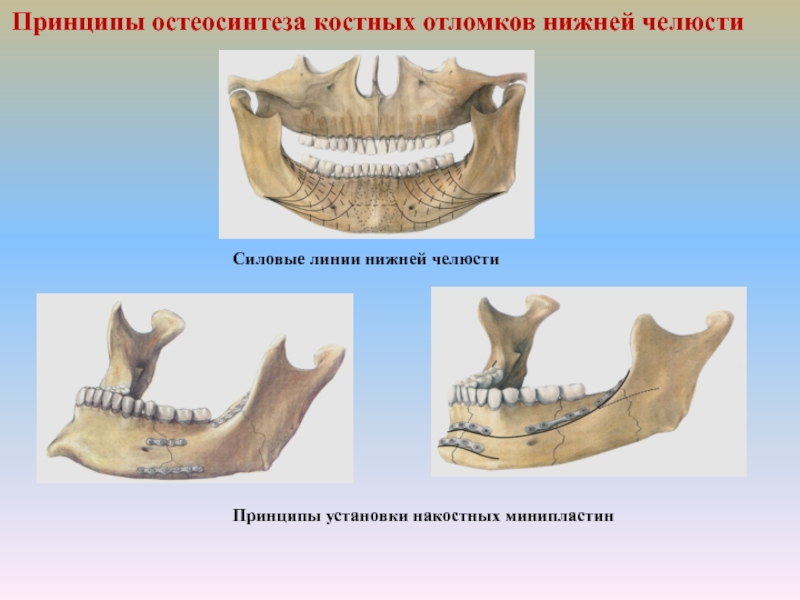 Методы временной и постоянной иммобилизации отломков челюстей презентация