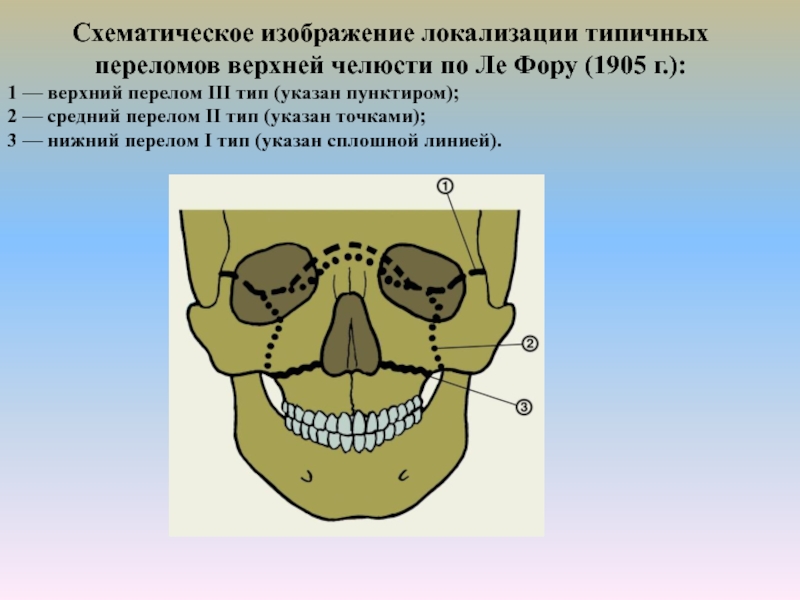 Перелом верхней челюсти презентация