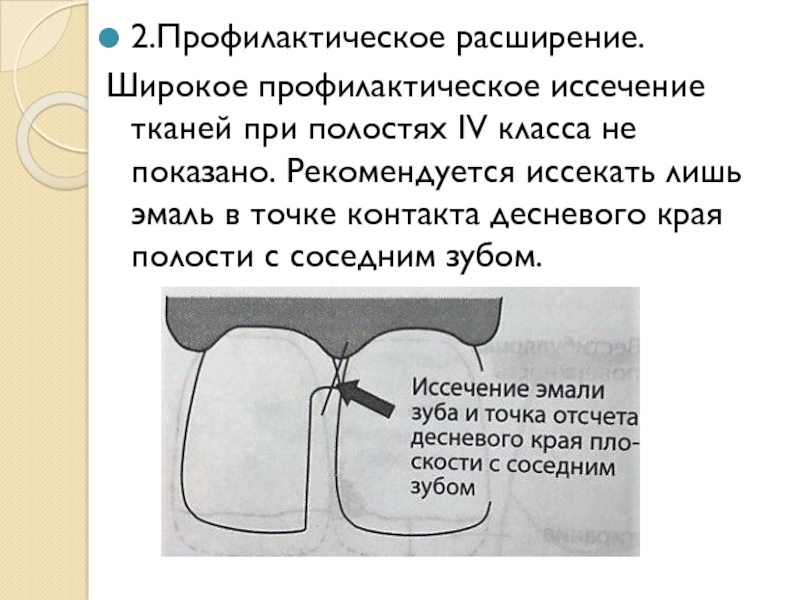 Кариозные полости 4 класса. Профилактическое расширение кариозной полости. Профилактическое расширение. Расширение полости (профилактическое расширение) зуба. Профилактическое расширение в полостях IV класса.