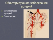 Облитерирующие заболевания артерий