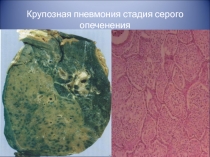 Крупозная пневмония стадия серого опеченения