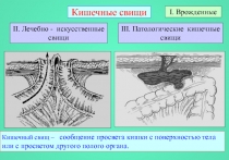 Кишечные свищи