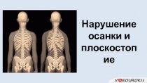 Нарушение осанки и плоскостопие