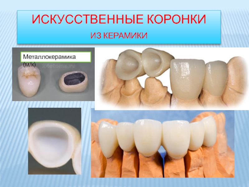 Искусственные коронки ортопедическая стоматология презентация