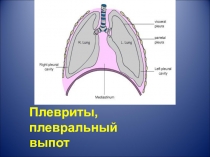 Плевриты, плевральный выпот