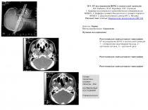 1811. КТ-исследование ВНЧС в аксиальной проекции. В.В. Баданин, Ю.И. Воробьев,