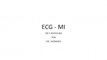 ECG - MI