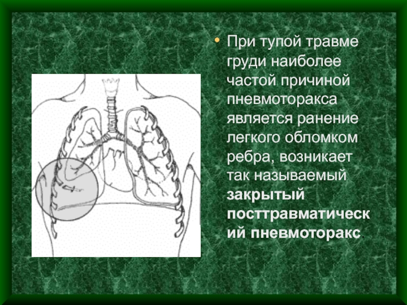 Презентация повреждения грудной клетки