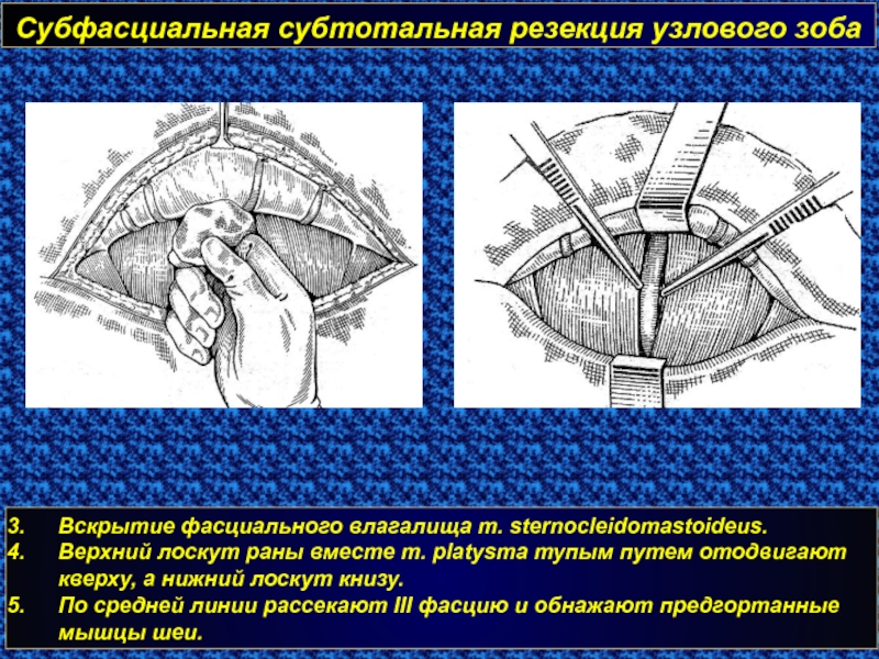 Субтотальная гистерэктомия презентация