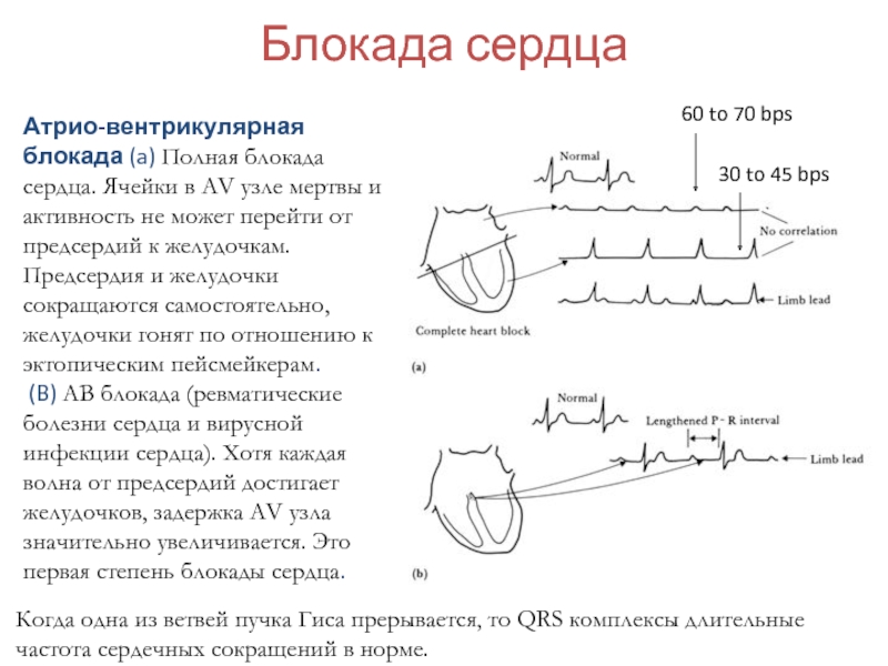 Блокада болезнь. Блокада левого клапана сердца. Блокада проводящей системы сердца ЭКГ. Поперечная блокада сердца 2 степени. Блокада желудочка сердца.