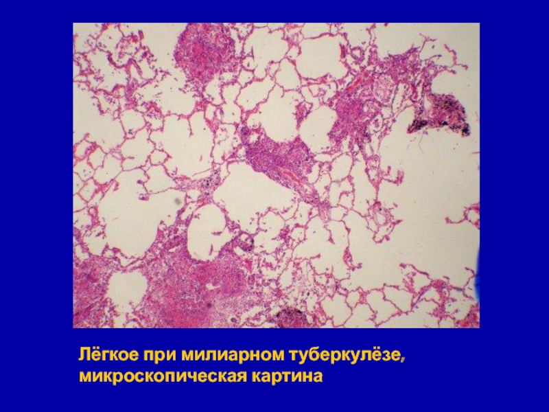 Туберкулезная каверна микропрепарат рисунок