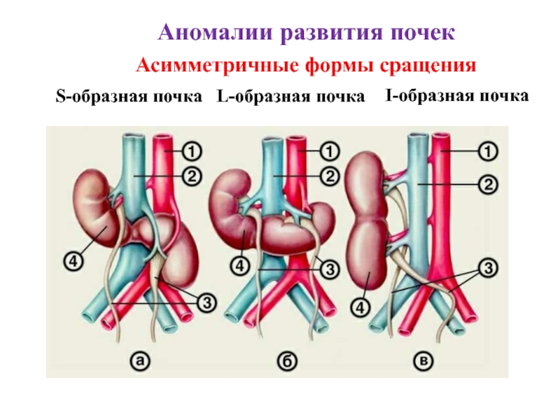 Аномалии почек презентация