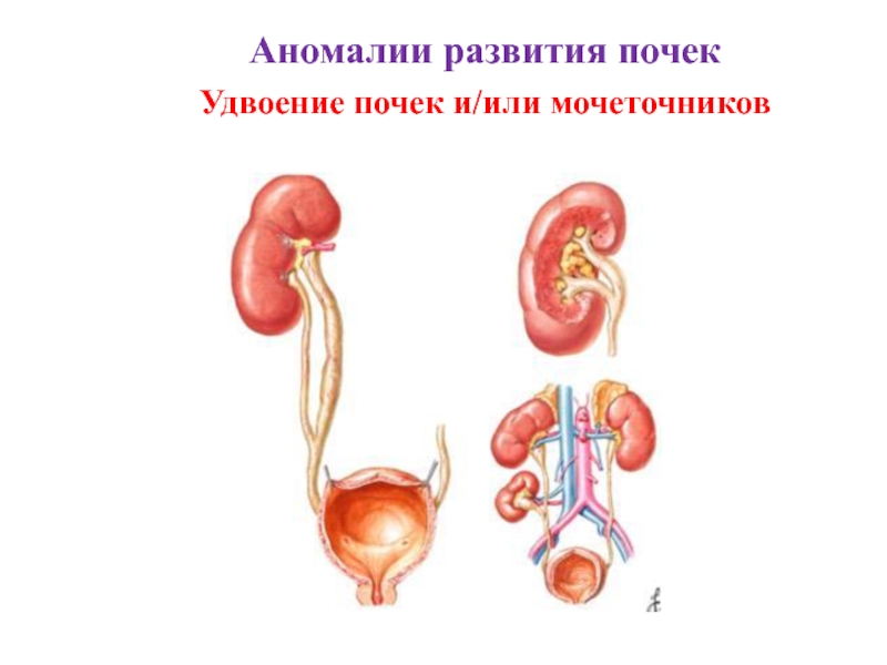 Аномалии мочеточников презентация