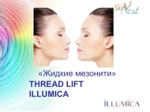 Жидкие мезонити
THREAD LIFT ILLUMICA